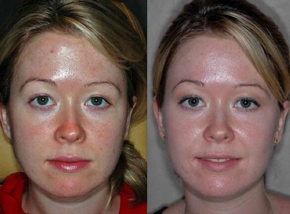 Fotos antes y después del rejuvenecimiento con plasma. 