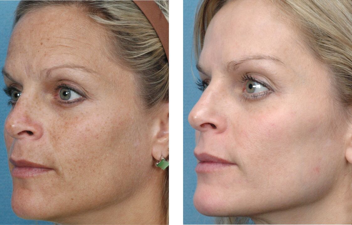 antes y después del rejuvenecimiento de la piel foto 1