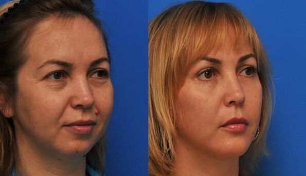 antes y después del rejuvenecimiento de la piel con estiramiento Foto 1