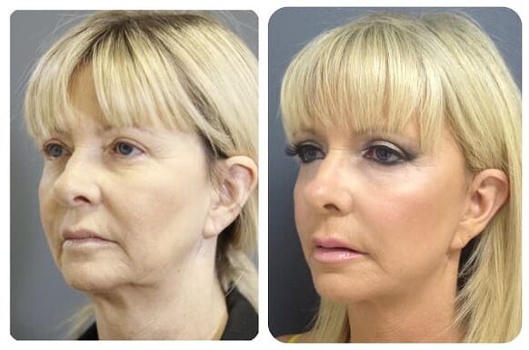 antes y después del rejuvenecimiento de la piel con estiramiento Foto 2