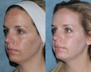 Antes y después de fraccionaria del rejuvenecimiento de la cara