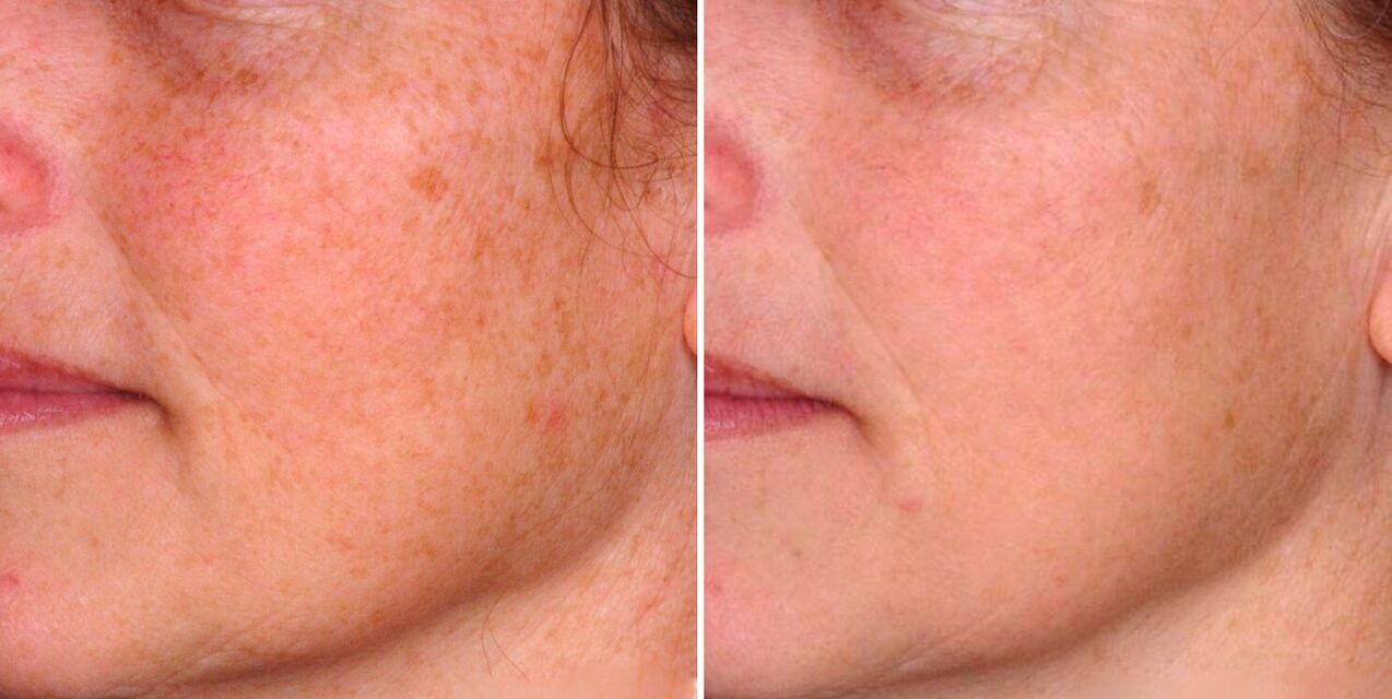 El resultado de la fototermólisis fraccionada es la reducción de las manchas de la edad en la piel del rostro. 